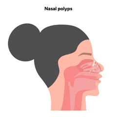 Nasal polyps, nose disease. Diagnostic and treatment. Medical diagram anatomy