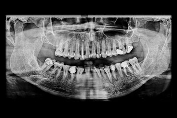 Dental panoramic x-ray showing a missing upper molar, multiple decayed teeth with fillings,...