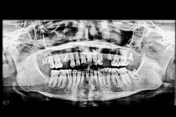Low-quality dental panoramic x-ray showing multiple missing teeth, periodontal disease or periodontitis, and severely decayed crowns, leaving only remaining roots embedded in the alveolar bone