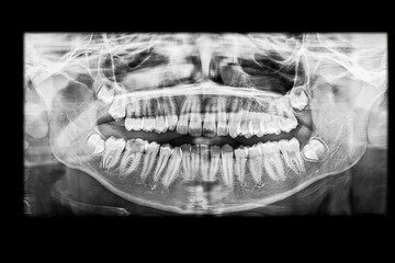 Dental panoramic x-ray of a teenager showing a decayed lower molar. The radiograph reveals dental...