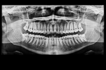 Dental panoramic x-ray diagnostic radiograph of an adult showing a complete, and aligned dentition, a restored upper molar with dental filling. Clear image of jaw structure, and surrounding bone.