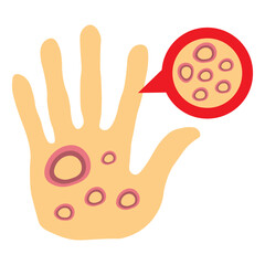 Ringworm on human hand illustration 