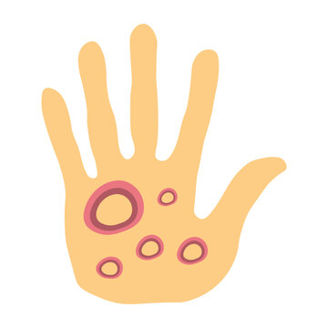 Ringworm on human hand illustration 
