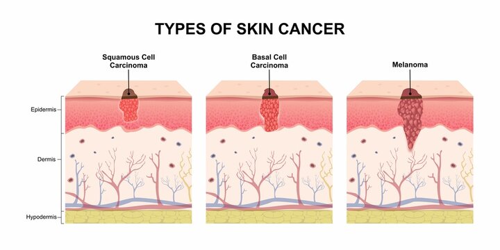 Types of Skin Cancer, Squamous Cell Carcinoma, Basal Cell Carcinoma, Melanoma Illustration
