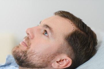 Obraz premium Aesthetic medicine. Doctor trichologist outlines the area of baldness on the client's head with a marker. The concept of alopecia and mesotherapy