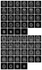 1 of the 12 Magnetic Resonance images series of a 67yo man.  MRI brain and brainstem: axial, coronal, and sagittal plane imaging with T1, T2, FLAIR, DWI, T2* sequences. Other images in the portfolio.