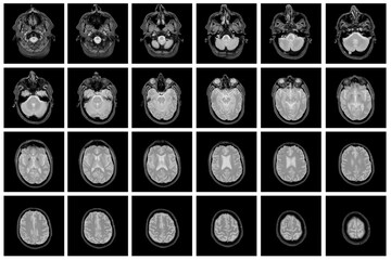 1 of the 12 Magnetic Resonance images series of a 67yo man.  MRI brain and brainstem: axial, coronal, and sagittal plane imaging with T1, T2, FLAIR, DWI, T2* sequences. Other images in the portfolio.