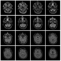 1 of the 12 Magnetic Resonance images series of a 67yo man.  MRI brain and brainstem: axial, coronal, and sagittal plane imaging with T1, T2, FLAIR, DWI, T2* sequences. Other images in the portfolio.