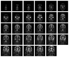 1 of the 12 Magnetic Resonance images series of a 67yo man.  MRI brain and brainstem: axial, coronal, and sagittal plane imaging with T1, T2, FLAIR, DWI, T2* sequences. Other images in the portfolio.