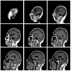 1 of the 12 Magnetic Resonance images series of a 67yo man.  MRI brain and brainstem: axial, coronal, and sagittal plane imaging with T1, T2, FLAIR, DWI, T2* sequences. Other images in the portfolio.