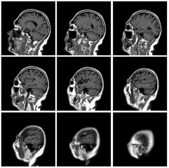 1 of the 12 Magnetic Resonance images series of a 67yo man.  MRI brain and brainstem: axial, coronal, and sagittal plane imaging with T1, T2, FLAIR, DWI, T2* sequences. Other images in the portfolio.