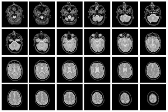 1 of the 12 Magnetic Resonance images series of a 67yo man.  MRI brain and brainstem: axial, coronal, and sagittal plane imaging with T1, T2, FLAIR, DWI, T2* sequences. Other images in the portfolio.