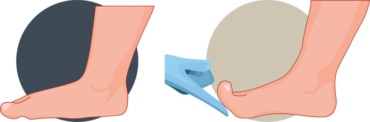 Jack test is to assess the functionality of the windlass mechanism and stability of the arch of the foot.
