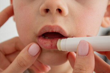 Mom applying lipstick to boy's dry lips