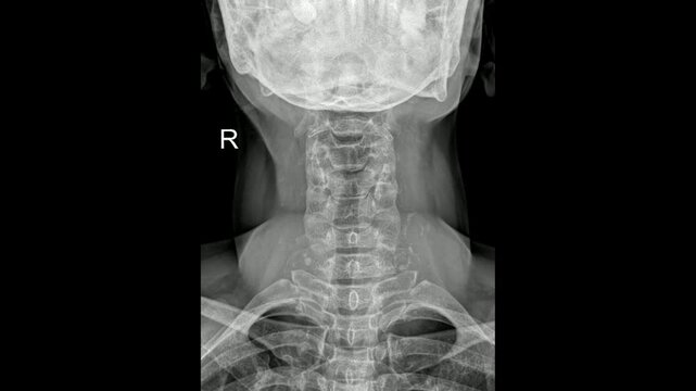 Neck AP X-Ray Showing Cervical Spine Alignment and Vertebral Structure