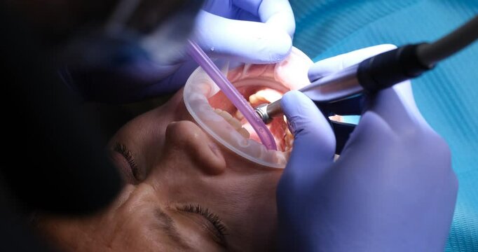Professional dentist cleans out decayed section of tooth. Doctor in protective gloves uses dental drill to remove damaged part of tooth of patient