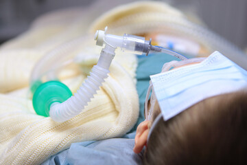 Little boy is under general anesthesia. Surgical intervention. Dental treatment under general anesthesia. Breathing tube in baby's mouth.