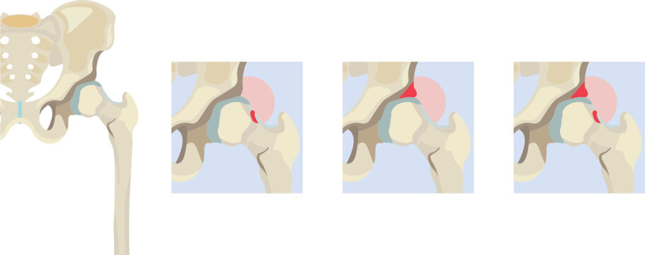 femoroacetabular impingement