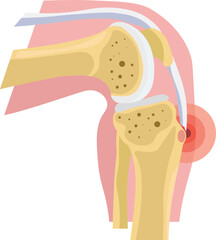 Osgood-Schlatter Disease