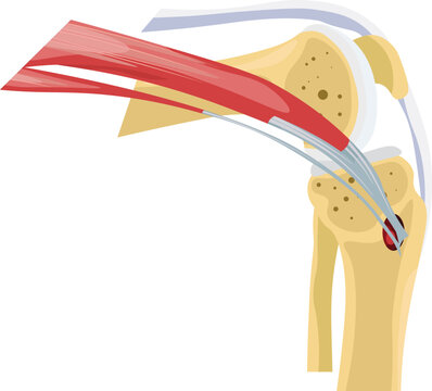pes anserine bursitis knee pain vector 