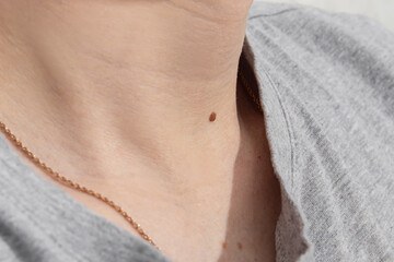 Large mole on the neck. Checking for moles