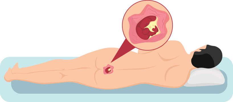 Pressure ulcers formation on bony parts of the body, such as the heels, elbows, hips and tailbone