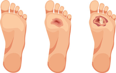 Diabetic foot ulcer