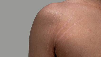 Fototapeta premium stretch marks on armpit skin area with clipping path
