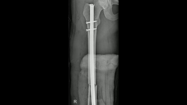Femur IM Nail X-Ray Demonstrating Bone Fixation and Healing