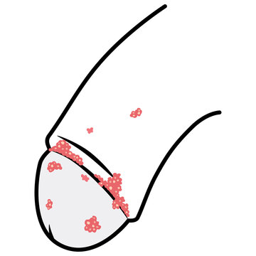 尖圭コンジローマ　男性生殖器にできたぶつぶつ