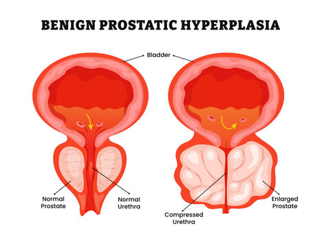 Benign prostatic hyperplasia anatomy, medical illustration poster, Enlarged prostate and normal prostate, cancer, BPH. Bladder or male reproductive system disease Inflammation, prostate gland.
