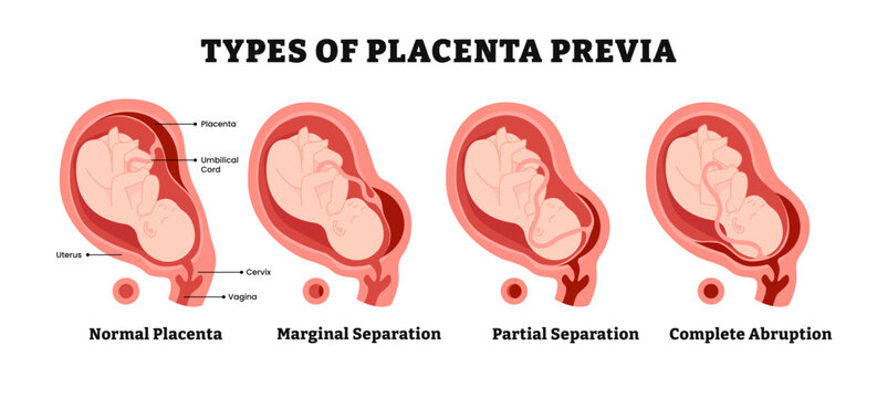 Different types of placenta previa, placental locations during pregnancy pathology, labeled normal, marginal separation, partial separation, complete abruption. placenta placement. Medical poster.