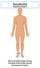 Fototapeta premium Achilles Tendonitis Illustration