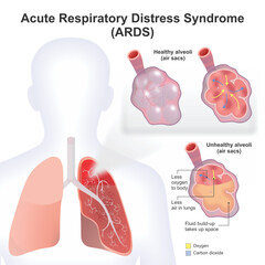 Acute Respiratory Distress Syndrome (ARDS)