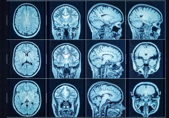 Closeup of a CT scan with brain. Medical, science and education mri background. Magnetic resonance...