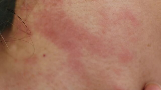Detailed view of irritated skin with redness and inflammation. Emphasizes the importance of dermatology and proper skincare.