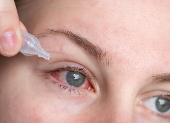 Close up of a woman applying eyedrops on red infected eye with conjunctivitis at home