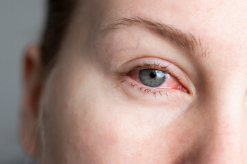 Close up of female face with one red eye suffering from infection conjunctivitis