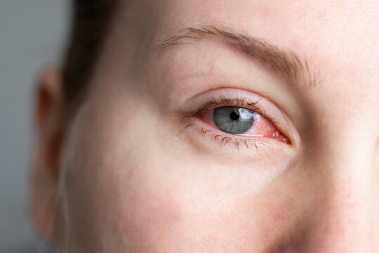 Close up of female face with one red eye suffering from infection conjunctivitis