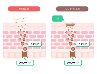 肌断面図で見せるシミのイラスト