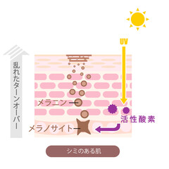 肌断面図で見せるシミのイラスト