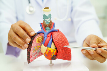 Cirrhosis, Liver cancer, fatty liver, Asian woman with liver human anatomy model.