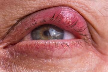 close up of disease barley on the eye. redness of the skin and inflammation of the hair follicle of...