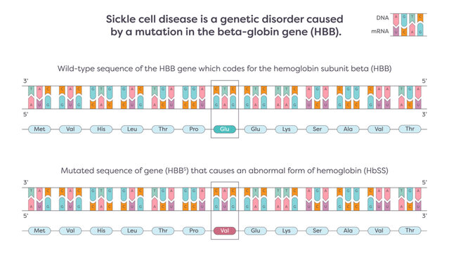 Sickle cell SNP mutation in the beta-globin HBB gene graphic illustration