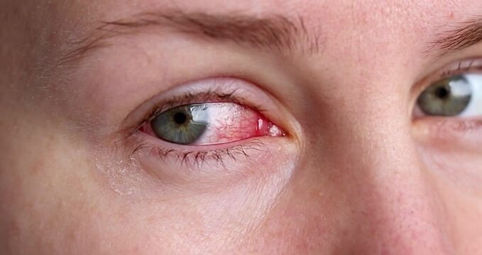 Close up of female face with one red eye suffering from infection conjunctivitis