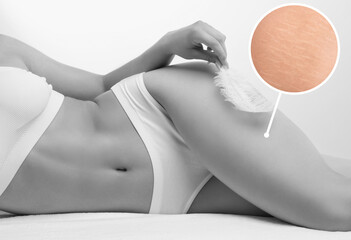 A woman after weight loss shows stretch marks on the skin of her legs and the outer and inner side...