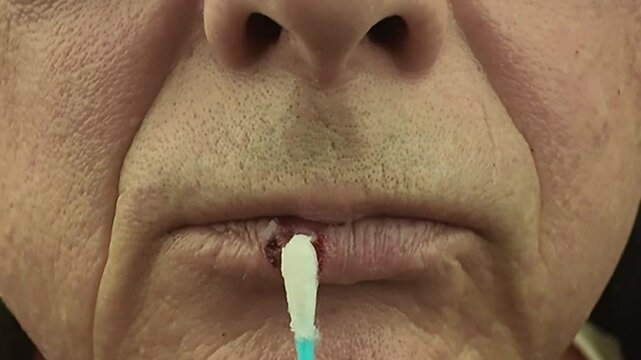 Lubrication of the cold sore with a cotton swab. Oral herpes on the lip. Cold sore on the mouth. Fever blister on lips. The concept of vitamins and healthy lifestyle