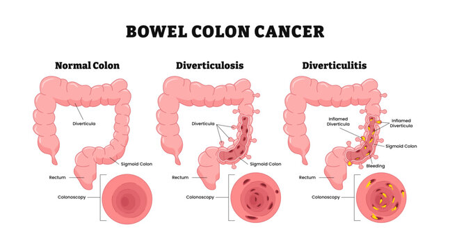 Different types of Bowel colon cancer, labeled healthy colon, diverticulosis, diverticulitis with colonoscopy. Diverticula, rectum, sigmoid colon. Colorectal colon. Medical illustration vector.