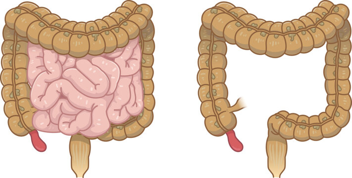 虫垂炎のイラスト appendiciti illustration