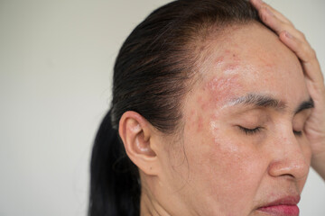 Obraz premium closeup acne on woman's face with rash skin ,scar and spot that allergic to cosmetics